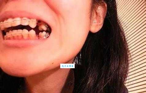 梦到掉牙齿是什么意思?是不是有什么预兆?