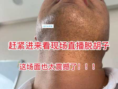 烦人的络腮胡怎么去掉？教你几招在家就能操作！