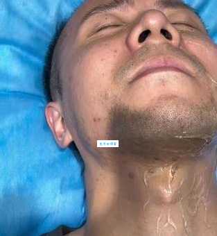 烦人的络腮胡怎么去掉?教你几招在家就能操作!