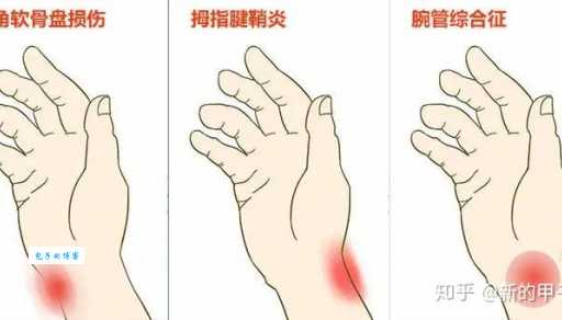 什么是鼠标手 手腕酸痛原来是它在作怪