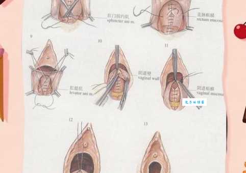 什么是割礼割哪里?新手必看快速入门指南!