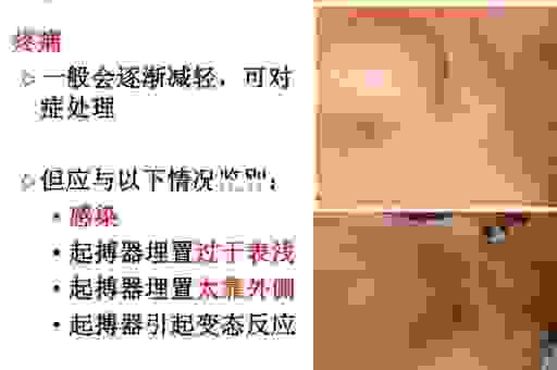 植入pacemaker起搏器价格多少？全面解析费用明细