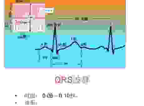 心电图显示flatline代表什么?如何判断病人情况危急