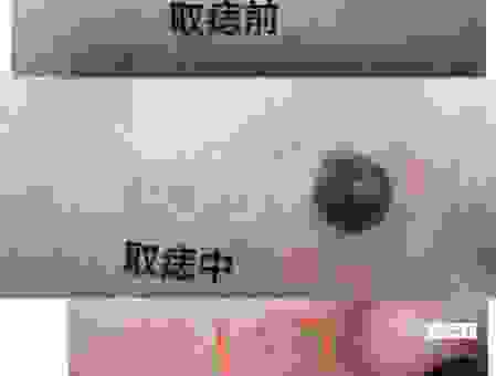 柔太痣是什么意思?皮肤科医生告诉你真相!